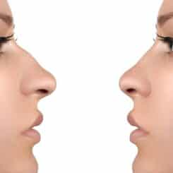 Rhinoplasty surgery is a type of surgery that can help straighten your nose