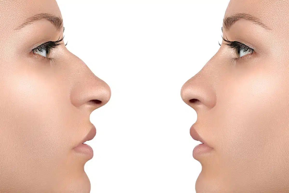 Rhinoplasty surgery is a type of surgery that can help straighten your nose