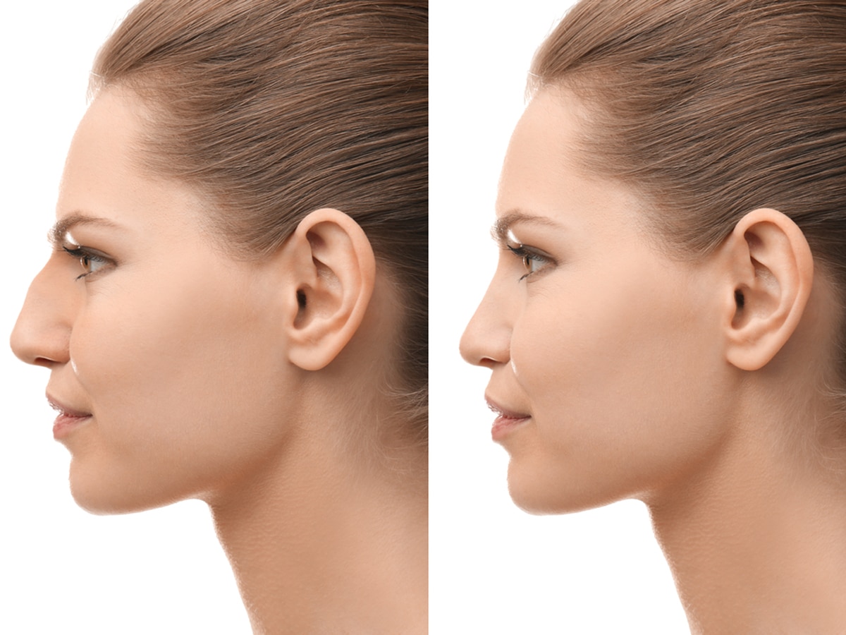 By undergoing a rhinoplasty procedure, such as dorsal hump removal, patients can achieve a straight profile and the desired shape of their nose.