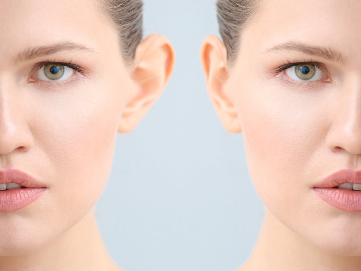 Otoplasty can help create a more natural appearance of the ears, improving balance with other facial features.