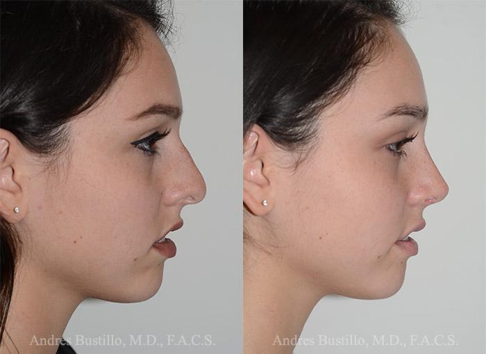 what is rhinoplasty