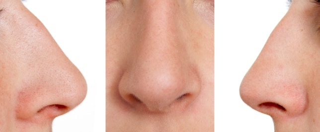 Have You Been Thinking of Remodeling Your Nose? 