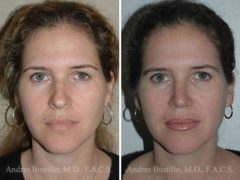 Rhinoplasty Before and After Photos in Miami, FL, Patient 15517