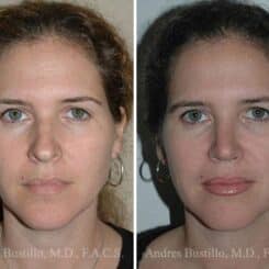 Rhinoplasty Before and After Photos in Miami, FL, Patient 15517