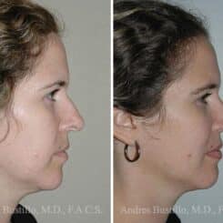 Rhinoplasty Before and After Photos in Miami, FL, Patient 15517