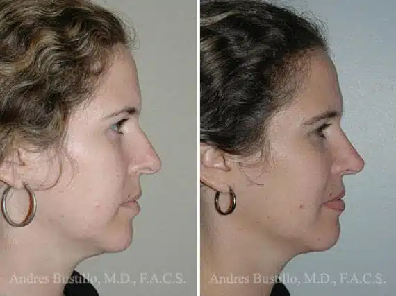 Rhinoplasty Before and After Photos in Miami, FL, Patient 15517