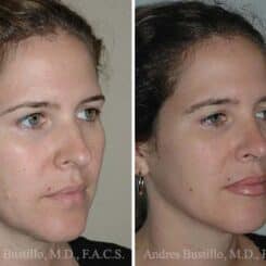 Rhinoplasty Before and After Photos in Miami, FL, Patient 15517