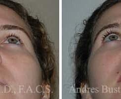 Rhinoplasty Before and After Photos in Miami, FL, Patient 15517