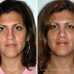 Rhinoplasty Before and After Photos in Miami, FL, Patient 15533