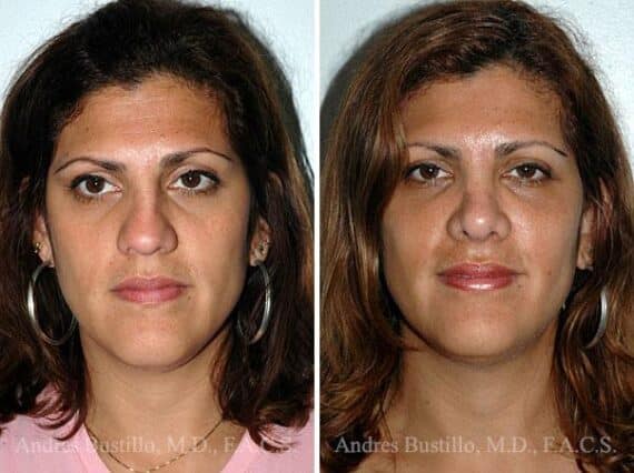 Rhinoplasty Before and After Photos in Miami, FL, Patient 15533