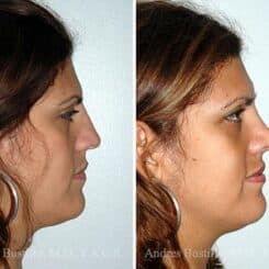 Rhinoplasty Before and After Photos in Miami, FL, Patient 15533