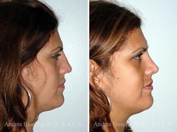 Rhinoplasty Before and After Photos in Miami, FL, Patient 15533