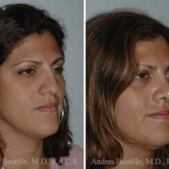 Rhinoplasty Before and After Photos in Miami, FL, Patient 15533