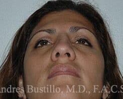 Rhinoplasty Before and After Photos in Miami, FL, Patient 15533