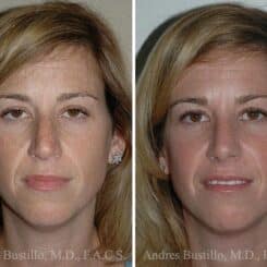 Rhinoplasty Before and After Photos in Miami, FL, Patient 15541