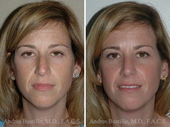 Rhinoplasty Before and After Photos in Miami, FL, Patient 15541