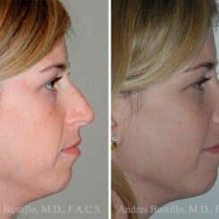 Rhinoplasty Before and After Photos in Miami, FL, Patient 15541