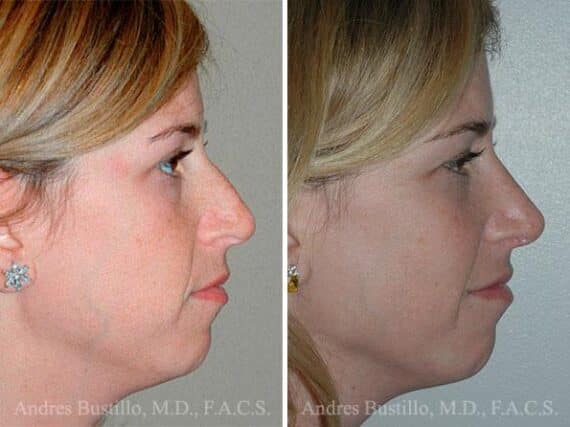 Rhinoplasty Before and After Photos in Miami, FL, Patient 15541