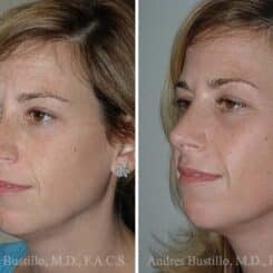 Rhinoplasty Before and After Photos in Miami, FL, Patient 15541