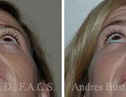 Rhinoplasty Before and After Photos in Miami, FL, Patient 15541