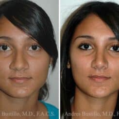 Rhinoplasty Before and After Photos in Miami, FL, Patient 15550