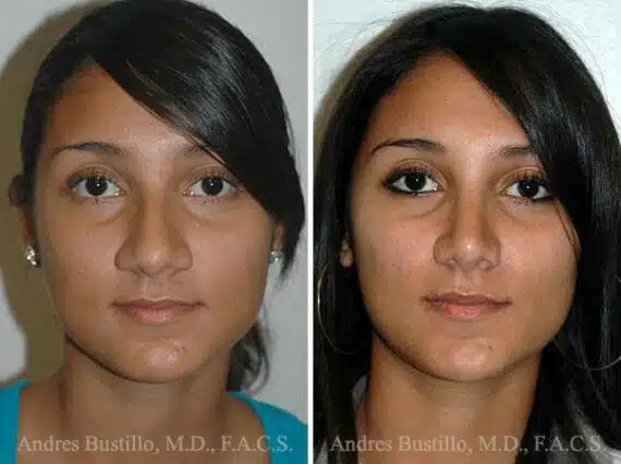 Rhinoplasty Before and After Photos in Miami, FL, Patient 15550