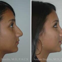 Rhinoplasty Before and After Photos in Miami, FL, Patient 15550