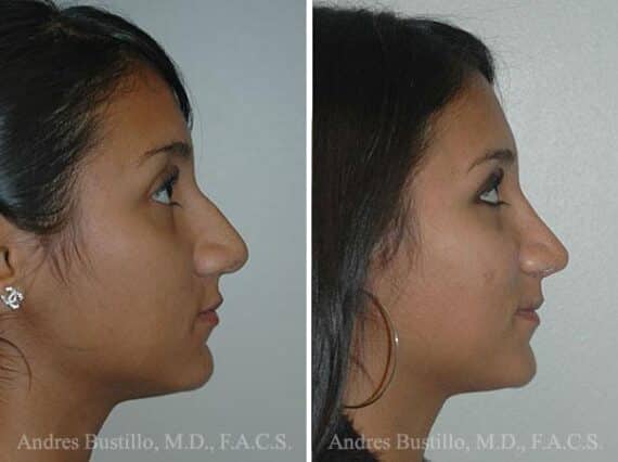 Rhinoplasty Before and After Photos in Miami, FL, Patient 15550