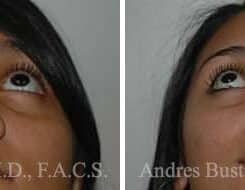 Rhinoplasty Before and After Photos in Miami, FL, Patient 15550