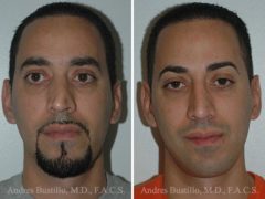 Rhinoplasty Before and After Photos in Miami, FL, Patient 15559