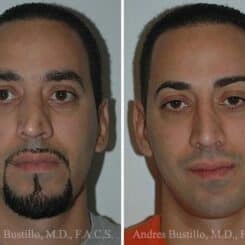 Rhinoplasty Before and After Photos in Miami, FL, Patient 15559