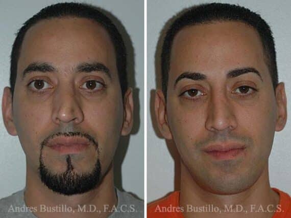 Rhinoplasty Before and After Photos in Miami, FL, Patient 15559