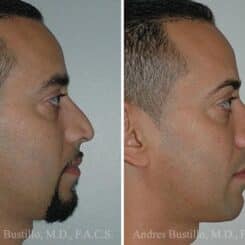 Rhinoplasty Before and After Photos in Miami, FL, Patient 15559