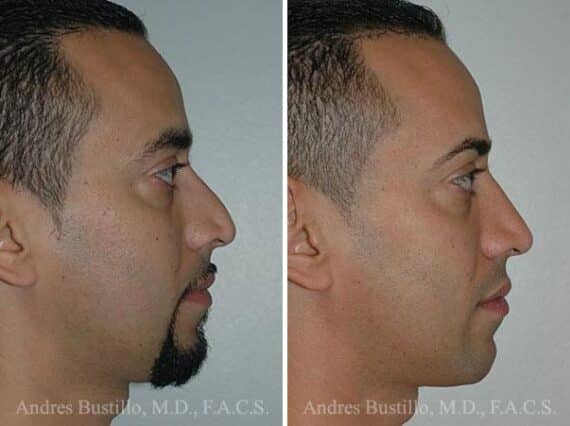 Rhinoplasty Before and After Photos in Miami, FL, Patient 15559