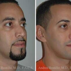 Rhinoplasty Before and After Photos in Miami, FL, Patient 15559