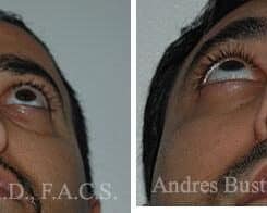 Rhinoplasty Before and After Photos in Miami, FL, Patient 15559