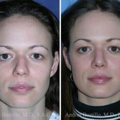 Rhinoplasty Before and After Photos in Miami, FL, Patient 15595