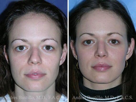 Rhinoplasty Before and After Photos in Miami, FL, Patient 15595