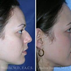 Rhinoplasty Before and After Photos in Miami, FL, Patient 15595