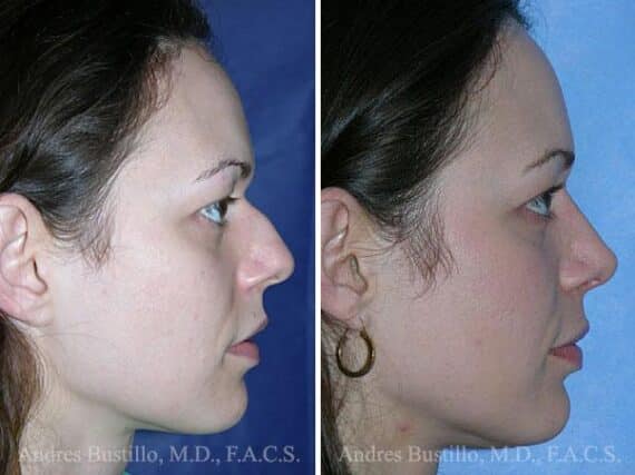 Rhinoplasty Before and After Photos in Miami, FL, Patient 15595