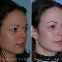 Rhinoplasty Before and After Photos in Miami, FL, Patient 15595