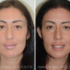 Rhinoplasty Before and After Photos in Miami, FL, Patient 15879