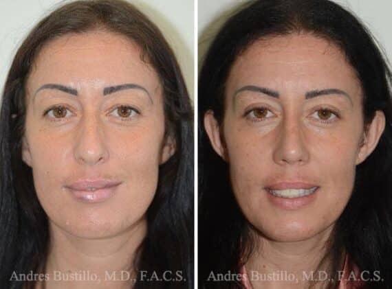 Rhinoplasty Before and After Photos in Miami, FL, Patient 15879