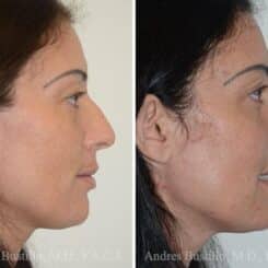 Rhinoplasty Before and After Photos in Miami, FL, Patient 15879