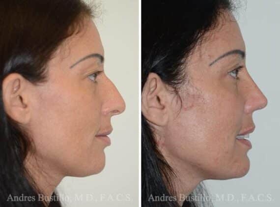 Rhinoplasty Before and After Photos in Miami, FL, Patient 15879