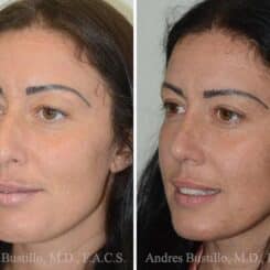 Rhinoplasty Before and After Photos in Miami, FL, Patient 15879