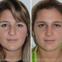 Rhinoplasty Before and After Photos in Miami, FL, Patient 15886