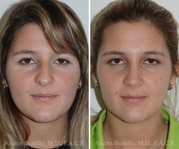 Rhinoplasty Before and After Photos in Miami, FL, Patient 15886