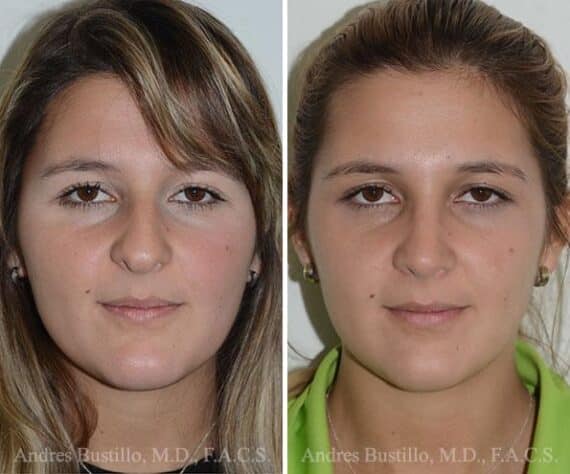 Rhinoplasty Before and After Photos in Miami, FL, Patient 15886