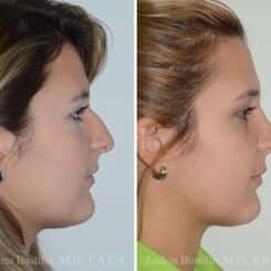 Rhinoplasty Before and After Photos in Miami, FL, Patient 15886